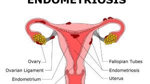 Endometrioma ve Endometriosis