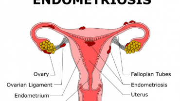 Endometrioma ve Endometriosis